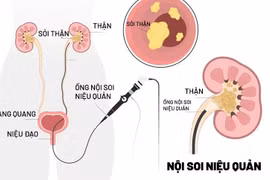 Bác sĩ nêu rõ chỉ định tán sỏi nội soi ngược dòng bằng ống mềm 