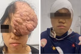 Người phụ nữ có khối u sụn xương sọ kích thước khổng lồ
