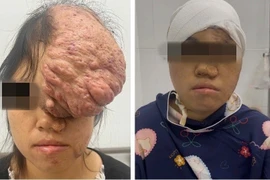 Người phụ nữ có khối u sụn xương sọ kích thước khổng lồ
