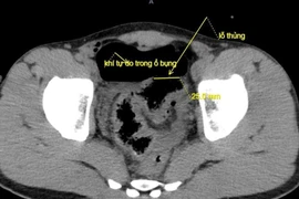 Cấp cứu thành công ca thủng đại tràng do bị vòi rửa xe xịt vào hậu môn