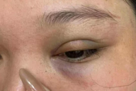 Người phụ nữ ở Hà Nội tố bị thanh niên lạ đánh gãy xương hốc mắt