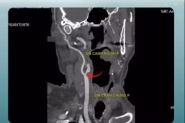 Cứu người đàn ông Israel ngất xỉu tại sân bay do tắc hoàn toàn động mạch cảnh