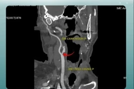 Cứu người đàn ông Israel ngất xỉu tại sân bay do tắc hoàn toàn động mạch cảnh