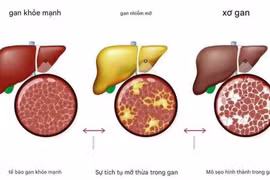 Gan nhiễm mỡ ở người gầy, nguy hiểm không thể chủ quan