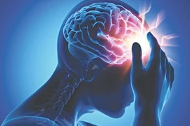Nguy cơ tái phát đột quỵ do rung nhĩ ở mức đáng báo động