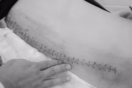 Phẫu thuật thành công vẹo cột sống 53 độ cho nữ bệnh nhân 18 tuổi