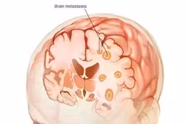 Các loại ung thư dễ di căn não