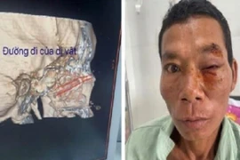 Cây chọc vào hốc mắt, nguy cơ mất thị lực vĩnh viễn