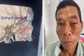 Cây chọc vào hốc mắt, nguy cơ mất thị lực vĩnh viễn