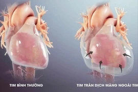Kịp thời cứu sống bệnh nhi bị tràn dịch màng ngoài tim