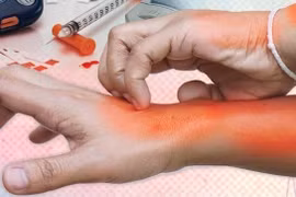 Da khô, ngứa... không ngờ dấu hiệu của đái tháo đường