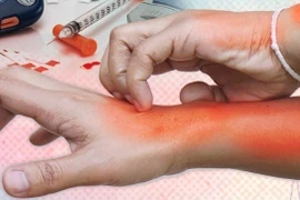Da khô, ngứa... không ngờ dấu hiệu của đái tháo đường