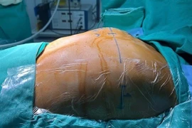 Phẫu thuật dị dạng lồng ngực cho bé trai 12 tuổi ở Phú Thọ