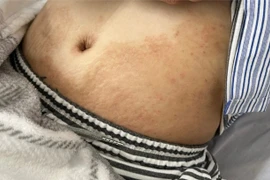 Người phụ nữ 28 tuổi ở Hải Phòng nhiễm 4 loại ký sinh trùng