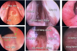 Điều trị phì đại tuyến tiền liệt bằng kỹ thuật Rezum hiện đại, an toàn