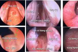 Điều trị phì đại tuyến tiền liệt bằng kỹ thuật Rezum hiện đại, an toàn