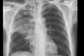 Điều trị thành công ca viêm phổi cộng đồng trên bệnh nhân xơ gan