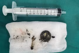 Bé 24 tháng nuốt pin cúc áo gây bỏng thực quản nguy hiểm