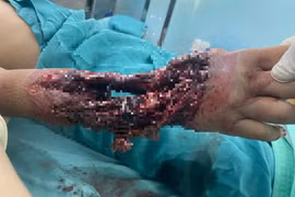 Hành trình hồi phục ngoạn mục cánh tay cho bé 10 tuổi