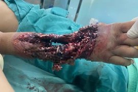 Hành trình hồi phục ngoạn mục cánh tay cho bé 10 tuổi