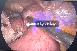 Nội soi cấp cứu người bệnh tắc ruột do dây chằng sau mổ