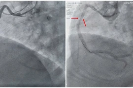 Ngưng tim đột ngột do rối loạn nhịp phức tạp gây nguy hiểm