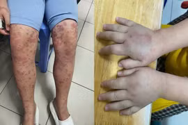 Tưởng ban xuất huyết dị ứng ai ngờ bệnh nguy hiểm 