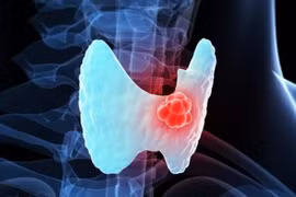 Vôi hóa nhân tuyến giáp có phải ung thư?