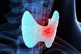 Vôi hóa nhân tuyến giáp có phải ung thư?