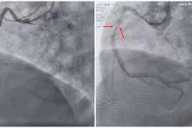 Ngưng tim đột ngột do rối loạn nhịp phức tạp gây nguy hiểm