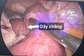 Nội soi cấp cứu người bệnh tắc ruột do dây chằng sau mổ