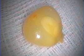 Cứu sống người phụ nữ bị sặc ngô, suy hô hấp nguy kịch