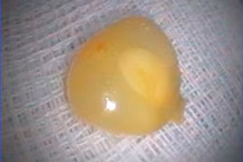 Cứu sống người phụ nữ bị sặc ngô, suy hô hấp nguy kịch