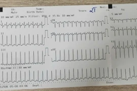 Chuyên gia cảnh báo nguy hiểm rối loạn nhịp tim ở trẻ nhỏ