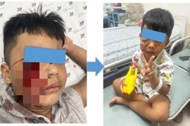 Cấp cứu trẻ 5 tuổi bị chó cắn rách nát mặt phải