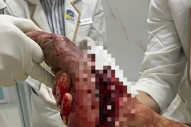 Nối lại thành công bàn chân đứt lìa do máy cắt cỏ