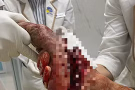 Nối lại thành công bàn chân đứt lìa do máy cắt cỏ