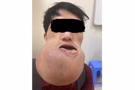 U xương khổng lồ khiến chàng trai ăn uống khó 