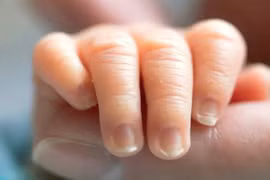 Bé sơ sinh bị suy hô hấp nặng hồi phục kỳ diệu 