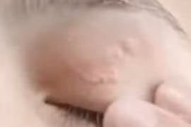 Kí sinh trùng 11cm làm tổ ở mí mắt cô gái 26 tuổi