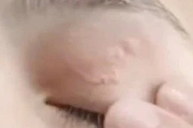 Kí sinh trùng 11cm làm tổ ở mí mắt cô gái 26 tuổi