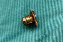 Bé 2 tuổi ở Phú Thọ thoát nguy kịch sau khi nuốt pin cúc áo