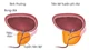 Kỹ thuật hiện đại điều trị tăng sinh tuyến tiền liệt