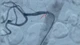 Đặt stent cứu cụ bà 85 tuổi mắc tăng huyết áp kháng trị uống thuốc không hạ