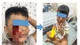 Bé 5 tuổi bị chó cắn hàng chục vết thương sâu ở mặt