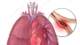 Nguy kịch do thuyên tắc phổi vì dùng thuốc tránh thai kéo dài 10 năm