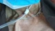 Tự cắt Catheter đường hầm lọc máu bệnh nhân chảy máu dữ dội