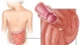 Đau bụng và khóc, trẻ 1 tuổi lồng ruột nguy kịch
