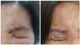 Đối tượng cần tiêm vắc xin Zona tránh biến chứng nặng