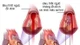 Đau thắt ngực theo chu kỳ có phải tổn thương động mạch vành?